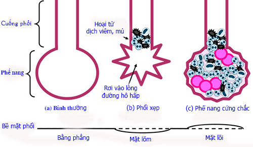 Hình 1: Những biến đổi của nang phổi Hình 1: Những biến đổi của nang phổi