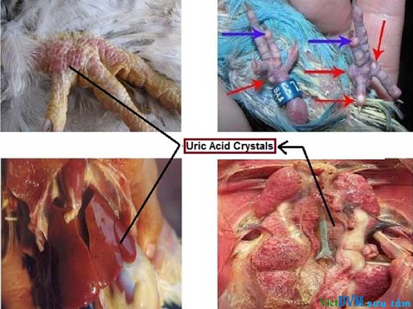 Tinh thể urat tích tụ trên các cơ quan nội tạng Tinh thể urat tích tụ trên các cơ quan nội tạng