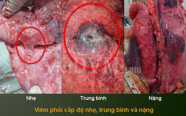 Viêm phổi cấp độ nhẹ, trung bình và nặng Viêm phổi cấp độ nhẹ, trung bình và nặng