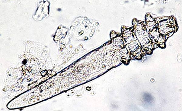 Mò bao lông Demodex qua kính hiển vi Mò bao lông Demodex qua kính hiển vi