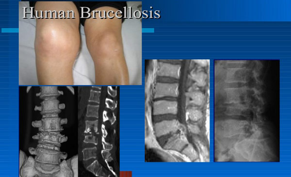 Bệnh có thể lây lan và gây ảnh hưởng nghiêm trọng lên người. Bệnh có thể lây lan và gây ảnh hưởng nghiêm trọng lên người.