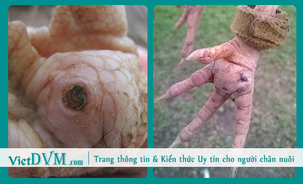 Tổn thương gan bàn chân. Tổn thương gan bàn chân.