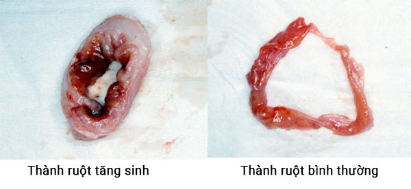 Thành ruột viêm tăng sinh dày hơn so với bình thường khá nhiều. Thành ruột viêm tăng sinh dày hơn so với bình thường khá nhiều.