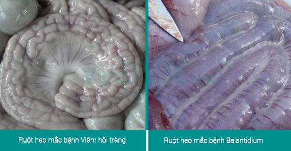Biểu hiện trên ruột rất điển hình của 2 bệnh Biểu hiện trên ruột rất điển hình của 2 bệnh