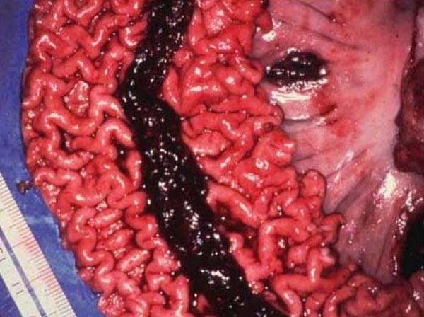 Một sợi dây máu đông đặc trưng của PHE Một sợi dây máu đông đặc trưng của PHE